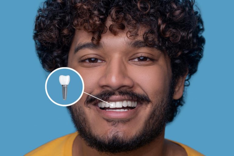 O que comer após a colocação do implante dentário