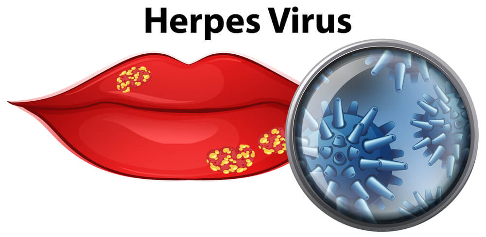 Afinal, o que é herpes labial