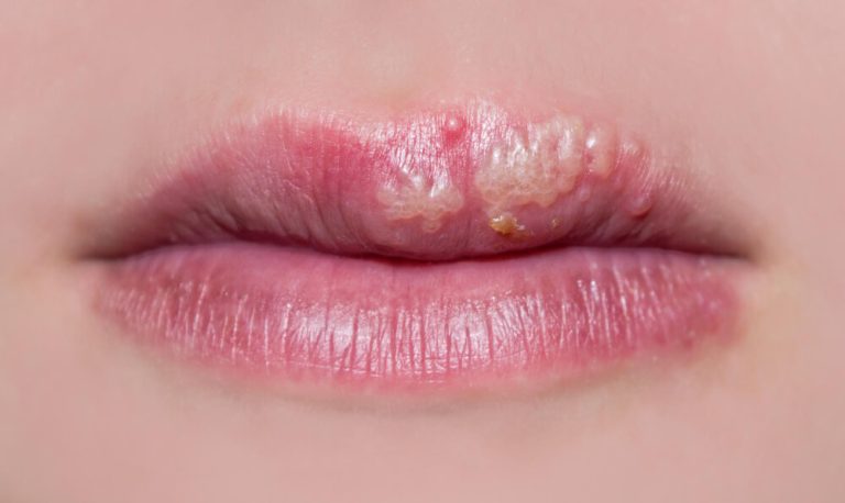 Herpes labial o que é, sintomas, causas e cuidados