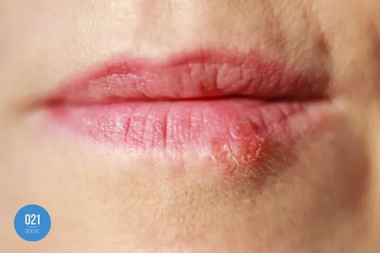 Boca com herpes labial no lado direito