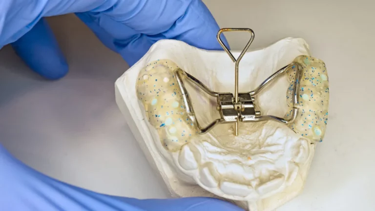 Aparelho para abrir o céu da boca colocado em molde da arcada dentária que está sendo segurado por uma mão com luva azul