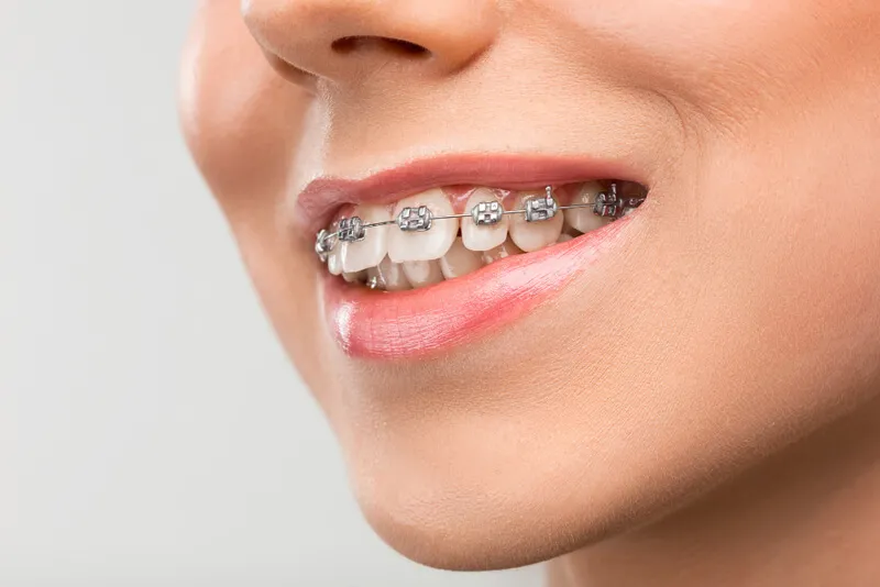Sorriso de uma pessoa que utiliza aparelho ortodôntico fixo
