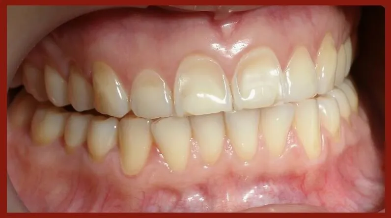 Boca com erosão dentária na arcada superior