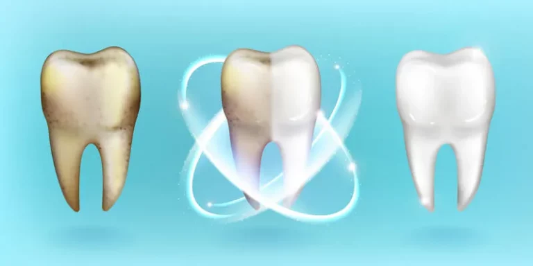 Imagem com um dente escuro, um que está sendo limpo e um dente branco