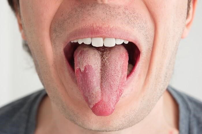O que é a candidíase oral