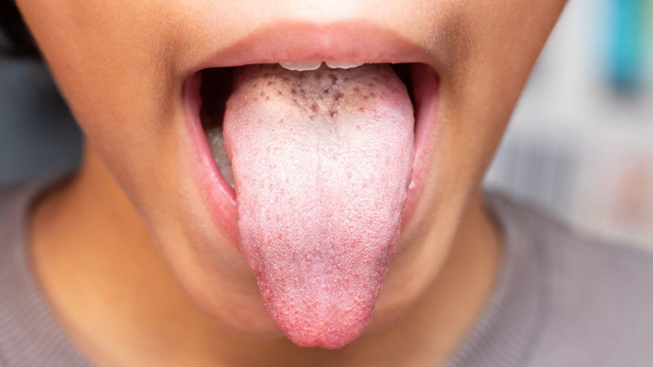 Língua Branca (bolinha ou mancha) – O que pode ser? E no bebê?