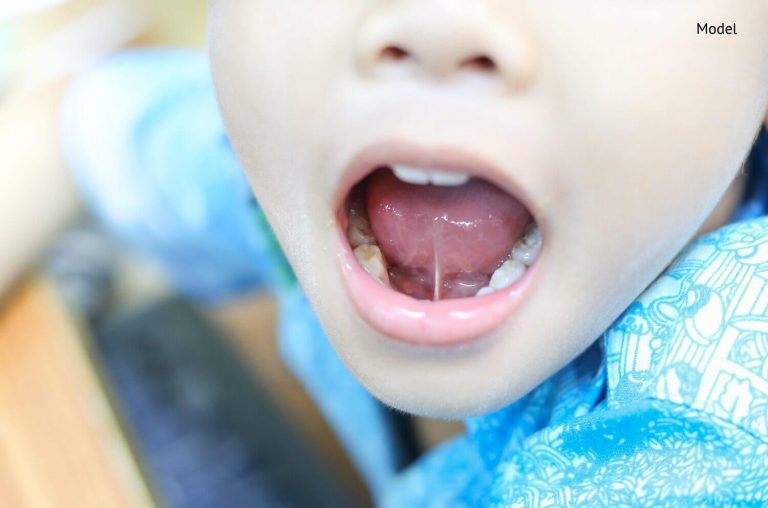 Cirurgia de Frenectomia Labial ou Lingual O que é E no bebê