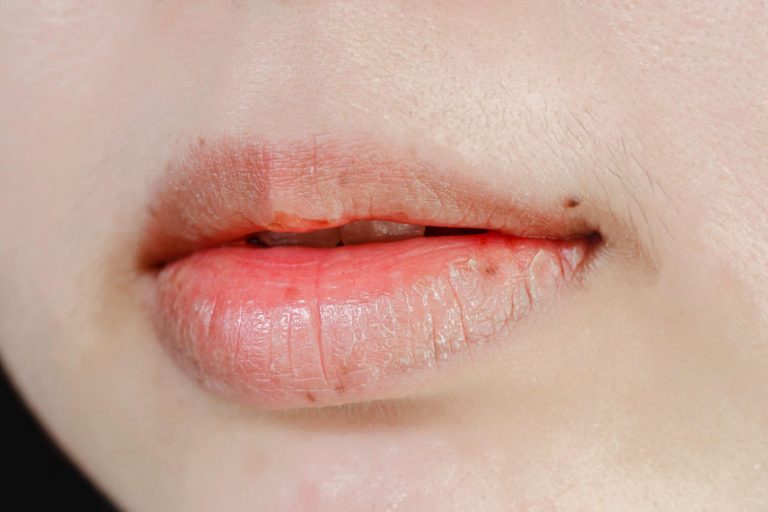 Inflamação dos lábios causas, sintomas e tratamentos
