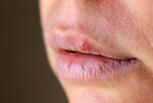 Espinha na Boca: Principais causas e o que fazer | BRdental
