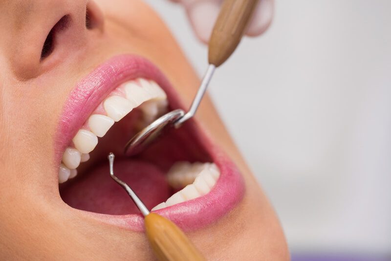 É necessário perfurar o dente