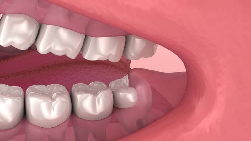 O Papel dos Dentes Molares na Saúde Bucal
