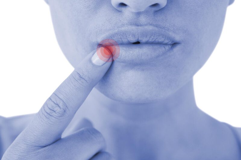 5 opções de tratamento para boqueira