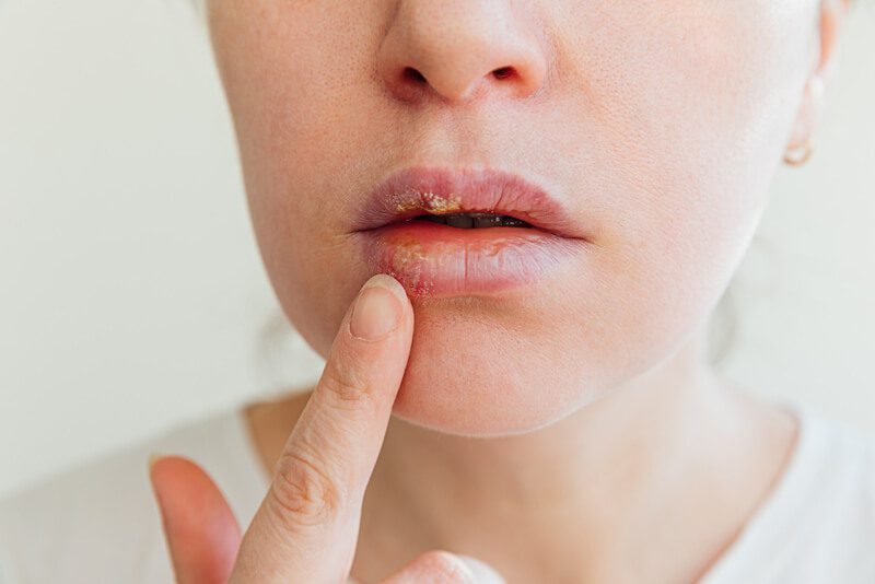 Como a herpes labial é transmitida