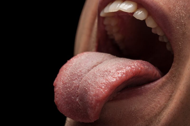 Quais formas de tratamento da papilite lingual transitória