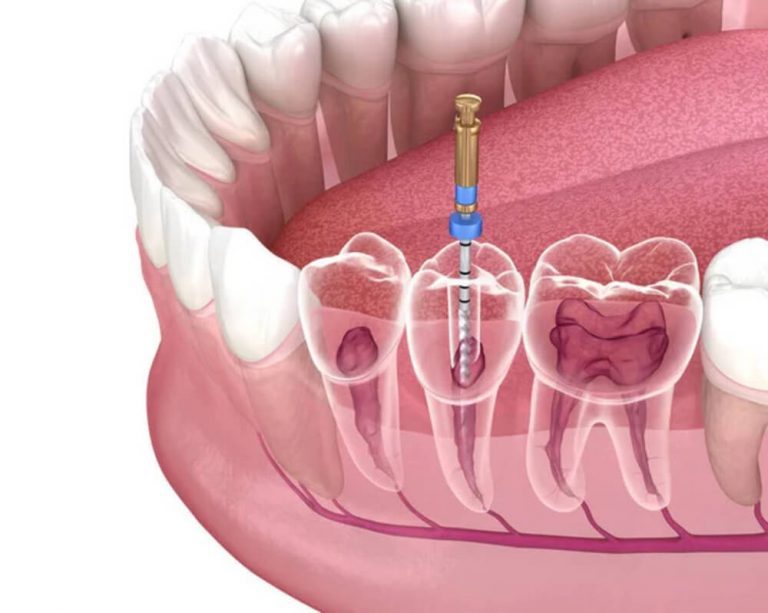 Canal no dente O que é quais os sintomas e como é feito o tratamento