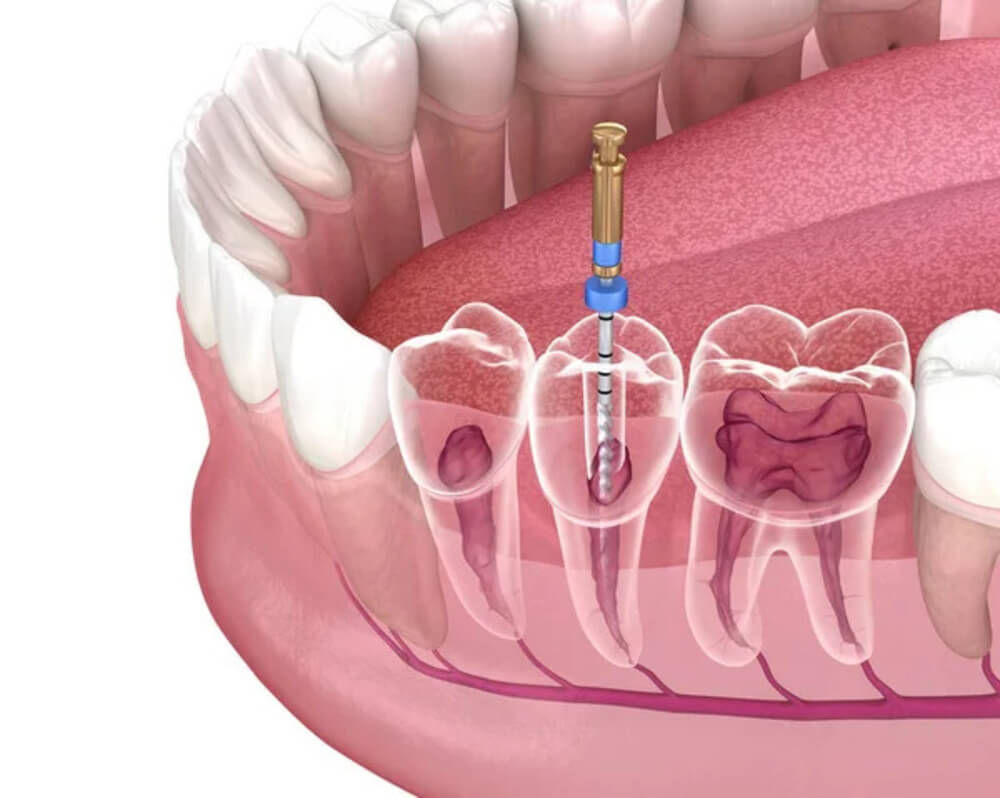 Canal no dente O que é quais os sintomas e como é feito o tratamento