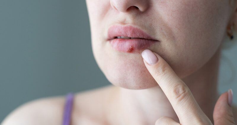 O que é herpes na boca