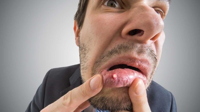 10 tratamentos recomendados para a afta