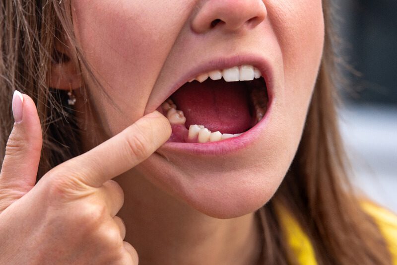 11 maneiras de restaurar o quadro de dente podre