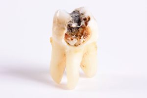 Dente podre Quando se constata e 11 maneiras de restaurá-lo
