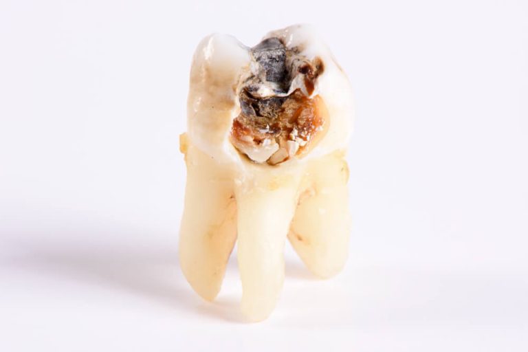Dente podre Quando se constata e 11 maneiras de restaurá-lo