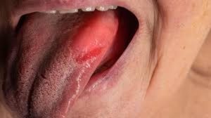 Leucoplasia O que é, causas e quais tratamentos existem