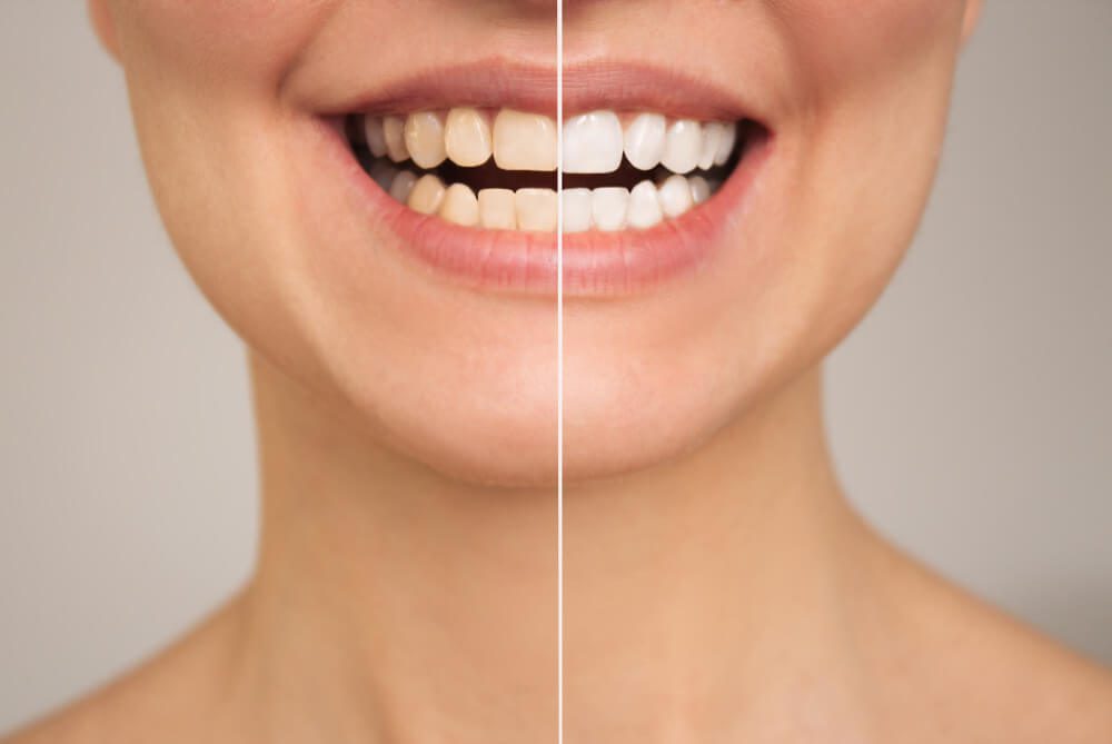 Clareamento dental